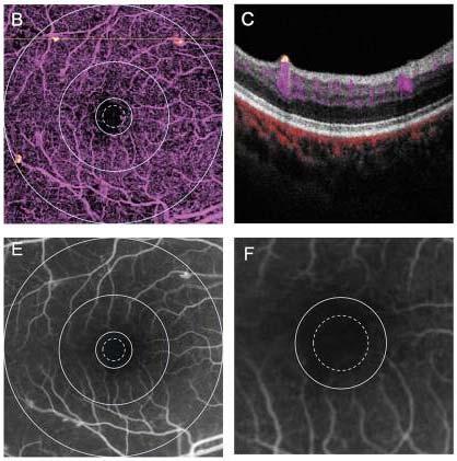 COOL Lab: Center for Ophthalmic Optics and Lasers Diabetic Retinopathy Identifying high risk biomarkers Total