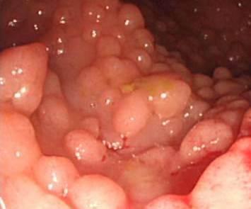 HEREDITARY:- Two distinct lines of hereditary spread of colon cancer are known a. Those in whom the colon is studded with small "grape-like" protrusions called polyps.