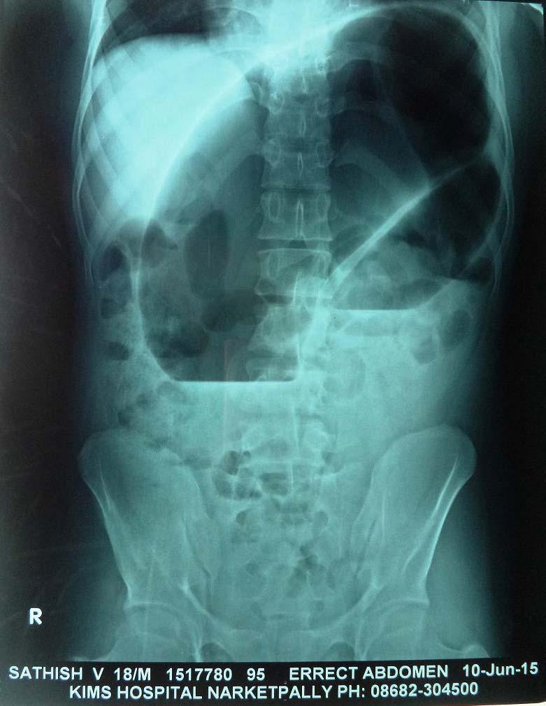 INVESTIGATIONS: X-RAY ERECT ABDOMEN Evidence of large dilated bowel loop showing Coffee-Bean Appearance is seen in left side of Abdomen extending into right side