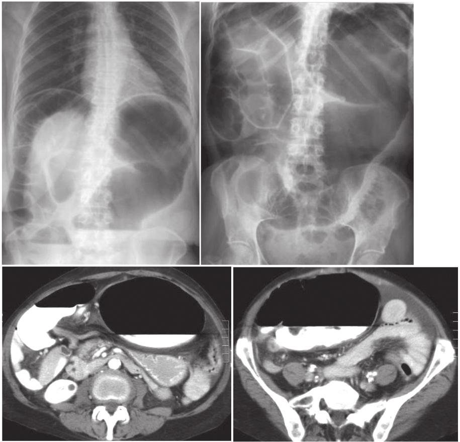112 Imaging of The Colon Case 3. A 46-year-old man presented with abdominal pain, and distension. Figure 3.