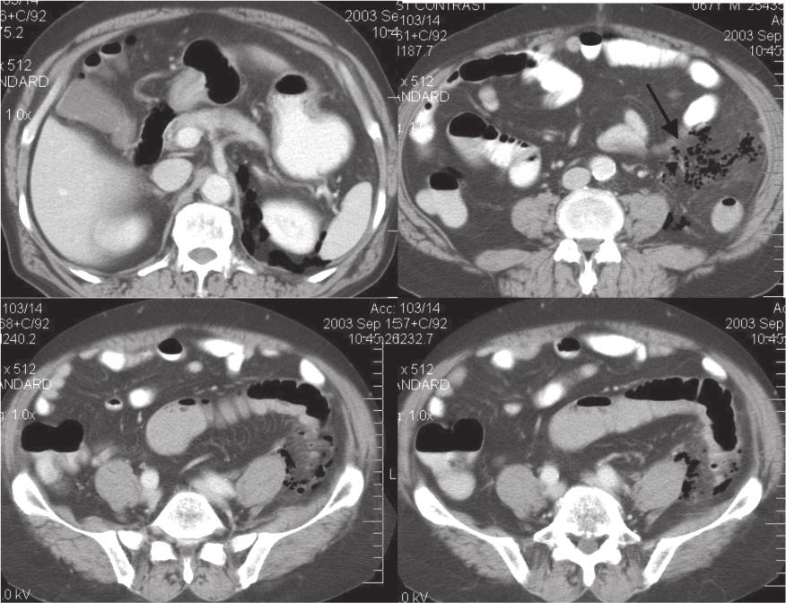 Pantongrag-Brown L THAI J Vol. 16 No. 2 May - Aug. 113 Case 4. A 55-year-old man presented with fever and abdominal pain. Figure 4.