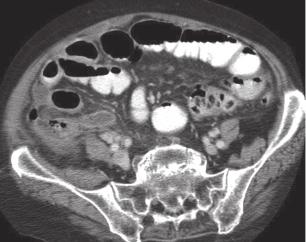 114 Imaging of The Colon Case 5. A 45-year-old male presented with fever and abdominal pain. Figure 5.