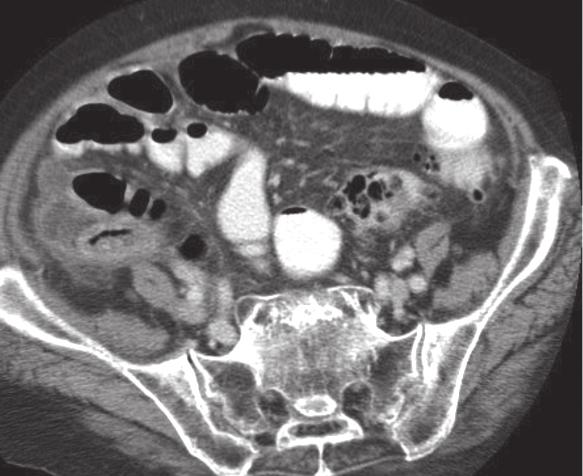 Findings are consistent with rupture acute appendicitis.