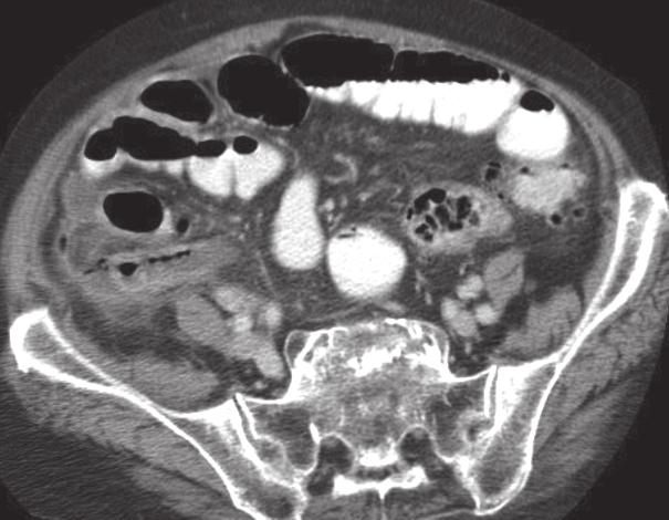 CT is highly sensitive and specific modality for the diagnosis of acute appendicitis.