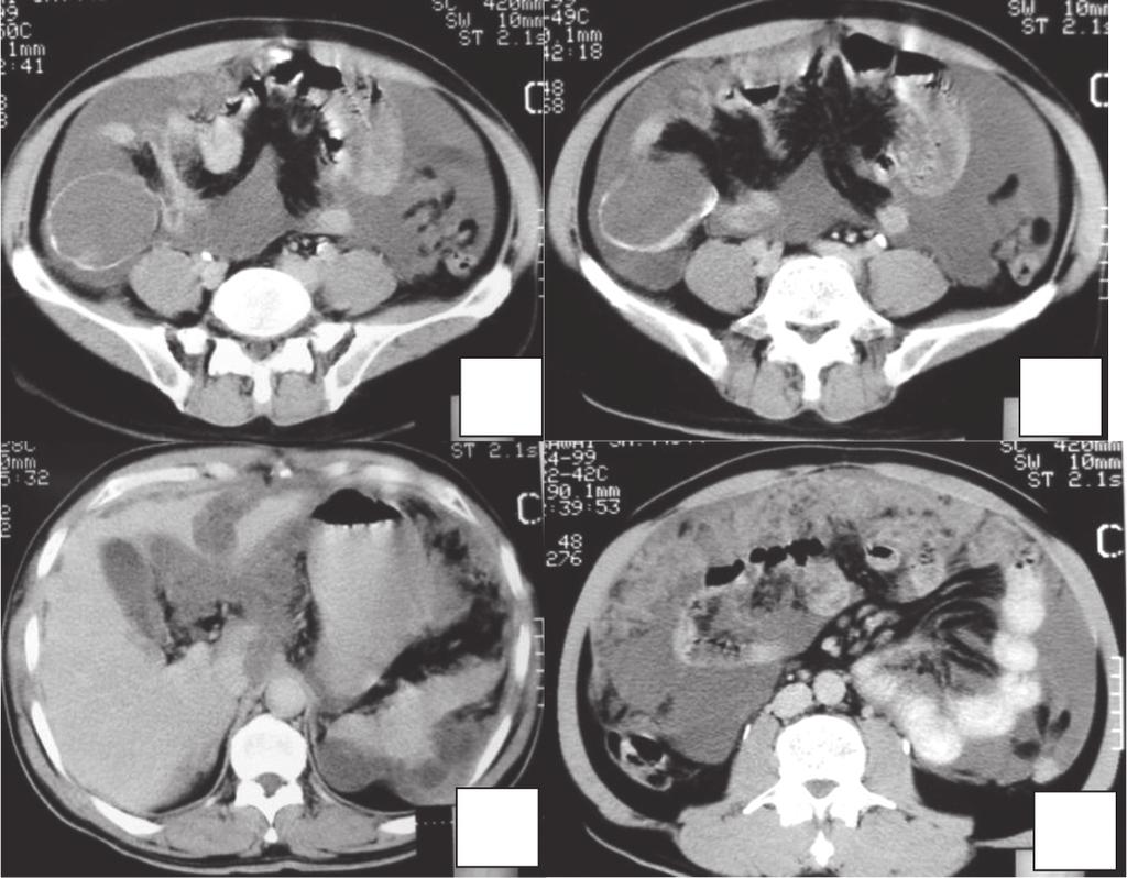 Pantongrag-Brown L THAI J Vol. 16 No. 2 May - Aug. 115 Case 6. A 45-year-old man presented with abdominal distension. A B C D Figure 6. case 6 CT shows ascites with a large omental cake (arrow, D).