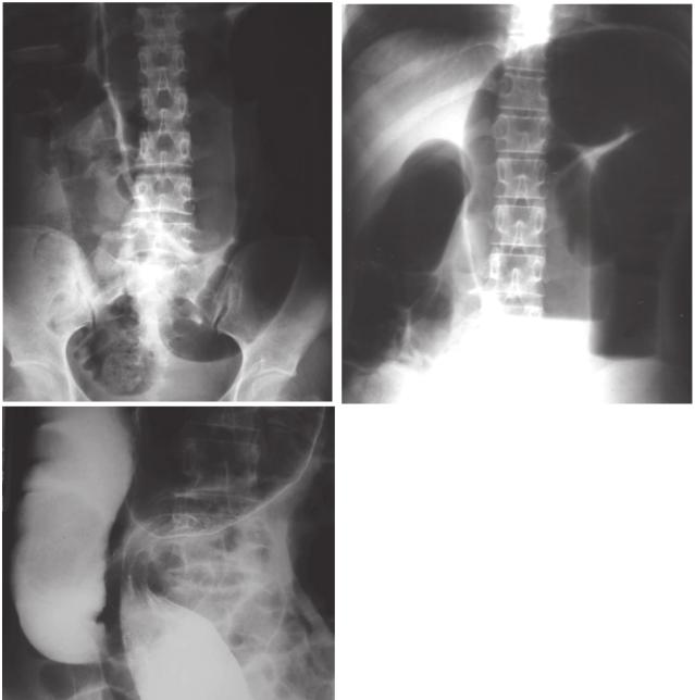 118 Imaging of The Colon Case 9. A 78-year-old man presented with abdominal pain and distension. Figure 9.
