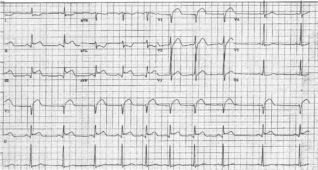 Acute Coronary Syndrome Unstable Angina / NSTEMI STEMI Time is Myocardium Key to ECG Diagnosis: -ST segment elevation (in contiguous leads / in
