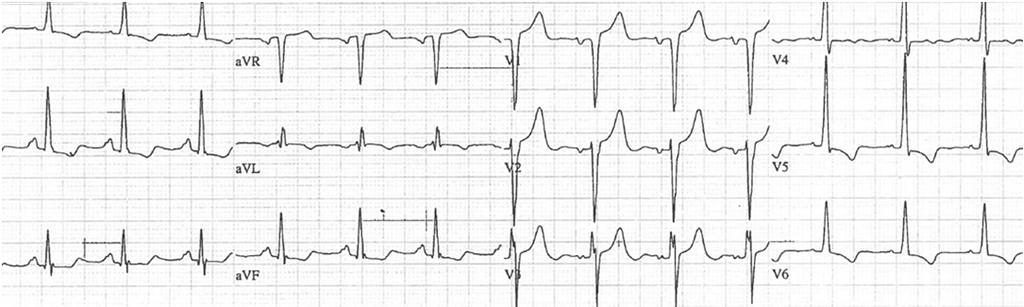 -SR -LVH -ST changes secondary to LVH -LA abnormality LVH -DX based on voltage criteria of QRS -Supported by other characterizations (LAE, LAD, secondary ST-T wave abnromalities, prolonged