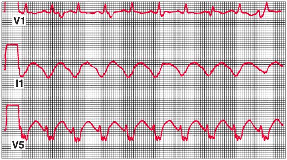 Ventricular tachycardia with AV dissociation P waves are