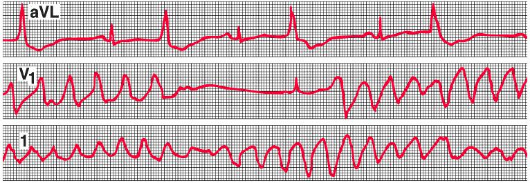Rhythm strips of patients with drug (disopyramide)-induced torsades de pointes