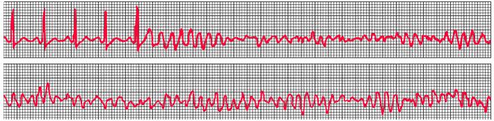 In a patient with coronary disease, ventricular fibrillation is initiated by an early ventricular premature complex that produces a rapid polymorphic