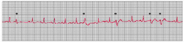 Ventricular Premature Complexes (VPCs) wide (usually >0.