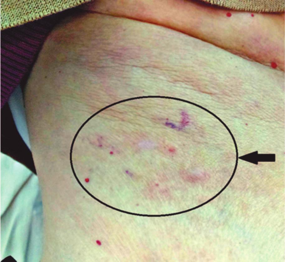 Fig. 1. Aspectul clinic al leziunii cutanate înainte de tratament Fig. 1. Clinical aspect of skin lesion before treatment Ciclofosfamidã.
