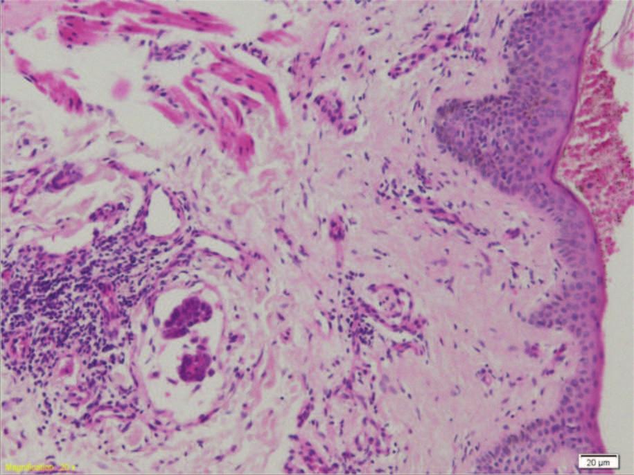 Fig. 2. Aspectul histopatologic în coloraþie hematoxilinãeoxinã, obiectiv 20X: emboli tumorali intralimfatici, formaþi din carcinom micropapilar Fig. 2. Histopathological appearance in hematoxylin-eoxin staining, 20X objective: intra lymphatic tumor emboli formed from micropapilar carcinoma Fig.