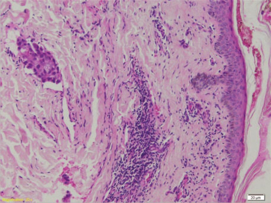 Histopathological appearance in hematoxylin-eoxin staining, 20X objective: intra lymphatic tumor emboli formed from micropapilar carcinoma Fig. 5. Aparatul de hipertermie localã Fig. 5. Local hyperthermia device Fig.
