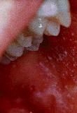 Viridans Streptococcus Alpha hemolysis No Lancefield groups Diseases Dental Caries