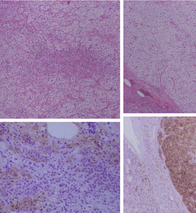 of large clear cells and small compact cells with positive immunostaining for (d) 3βHSD and (e) P450c17, and (f) a microadenoma composed of large clear cells with positive immunostaining for (g)