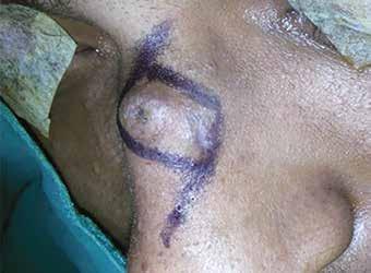 6: Skin marking for incision, complete excision and reconstruction of surgical wound Fig.