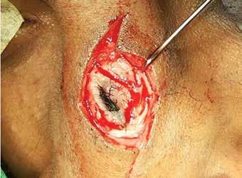 modified bipedicle advancement flap) which is corrected by excising a small triangular skin