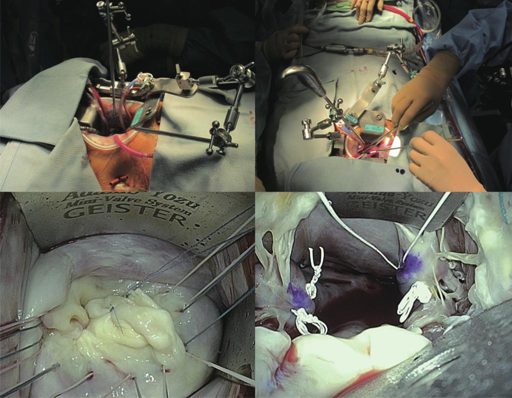 366 Okamoto and Yozu. Forward-thinking devices for surgeons A B C D Figure 1 Adams-Yozu Mini-Valve System.