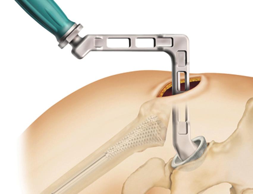 Acetabular Preparation and Component Insertion Use the 45 degree angle acetabular reamer handle to ream the socket appropriately.