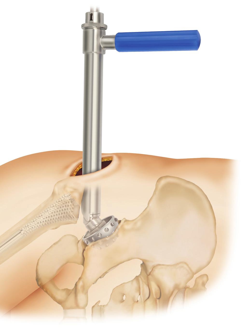 Trial Reduction Replace the smaller broach that was used for the neck osteotomy with the final broach. Place the trial head into the socket.