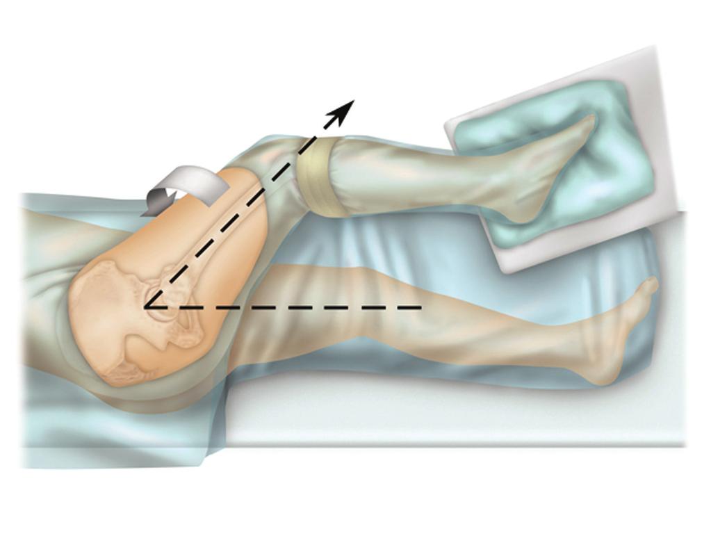 Patient Positioning The patient is positioned in the lateral position with the body positioned slightly toward the anterior side of the table so the hip can be maximally adducted.