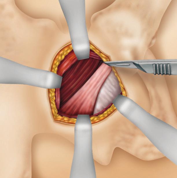 A blunt pull retractor is then placed on the piriformis tendon and pulled inferiorly to move the posterior border of the gluteus medius out of the way to maximally expose the piriformis tendon as