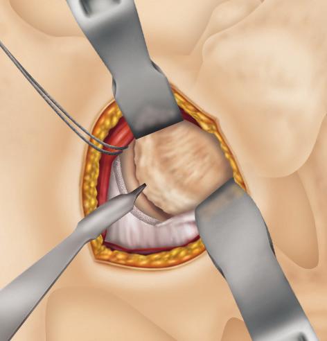 Sharp dissection with a knife may be necessary to begin mobilization of the minimus. The interval between the minimus tendon and the anterior hip capsule should be developed with a Cobb elevator.