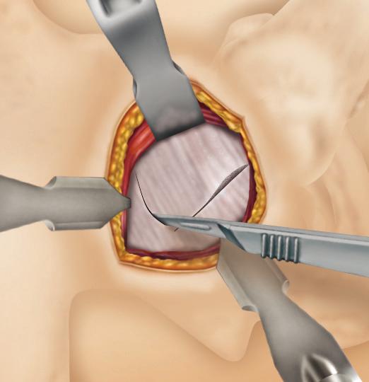 In addition, an impacting spiked Hohmann retractor can be placed anteriorly, just under the minimus and into the ilium, just above the acetabular rim.
