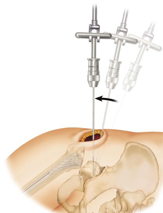 Femoral Head Removal Place a Cobb elevator at the head/socket junction and rotate the head into a little valgus. Place a long Schanz screw into a solid part of the head.