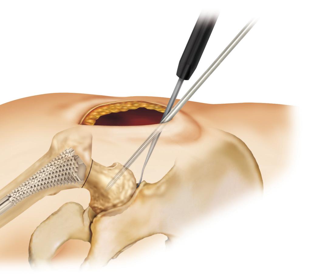 Similarly, place a small sharp impacting Hohmann retractor into the mid-posterior socket region, again, inside of the capsule but outside the labrum.