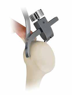 Step 2: Move the Slide towards the anterior edge of humeral head. Ensure Slide is exactly on the anatomic neck (Figure 7).