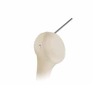 Rotate Thumb Screw counter-clockwise and retract Slide away from bone.