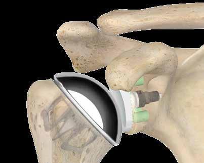 17 Sidus Stem-Free Shoulder Surgical Technique Figure 20 Sidus Shoulder with Glenoid Glenoid Options At this point the glenoid can be prepared.