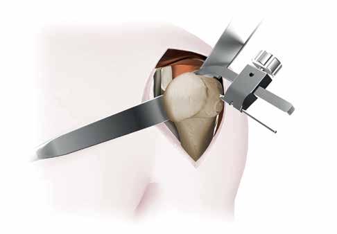 9 Sidus Stem-Free Shoulder Surgical Technique Thumb Screw Slide Finger K-Wire Humeral Head Identification, Preparation and Resection Expose humeral head and identify anatomical neck landmarks Two