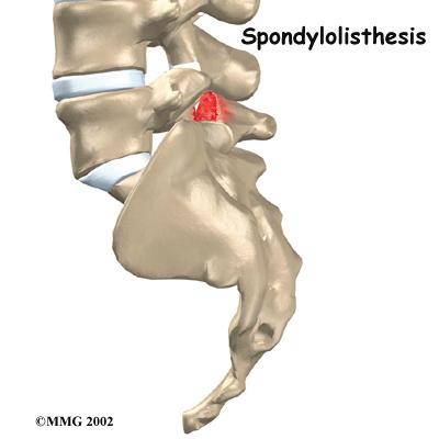 Introduction Normally, the bones of the spine (the vertebrae) stand neatly stacked on top of one another. Ligaments and joints support the spine. Spondylolisthesis alters the alignment of the spine.