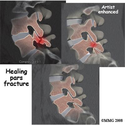 It can help in the diagnosis of spondylolisthesis. It can also provide information bout the health of nerves and other soft tissues. Treatment What treatment options are available? is recommended.