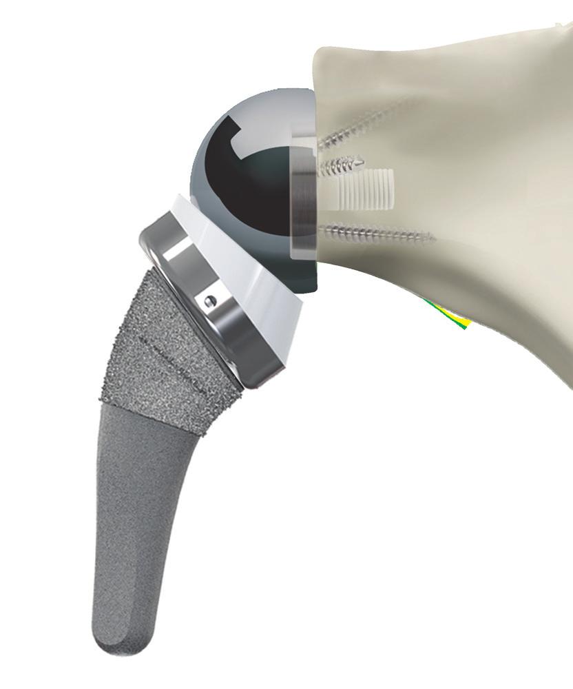 Extensive reversed glenoid options provide optimal fixation and intra-operative