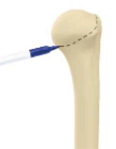 Humeral Head Preparation With the humeral head dislocated, remove all osteophytes.