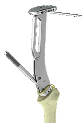 Locking the Compactor Inclination If preparing for a reversed implant, loosen the handle of the Inserter Handle and leave the Compactor inside the humerus as the trial implant.