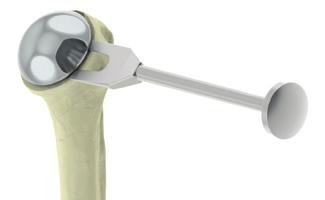 Removing the Humeral Head To begin, remove the Humeral Head by placing the tips of the Distractor between the resection and bottom of the Humeral Head and impact to free the Morse taper.