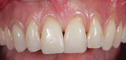Introduction Gingival recession is associated with attachment apparatus loss.