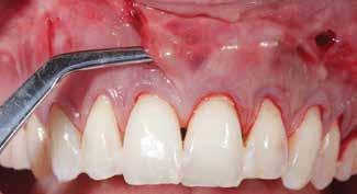Kuday/Kuday Aalam/Aalam/Choukroun APRF Volume The authors recommend a minimum of three to four membranes per pair of teeth to see clinical significance.