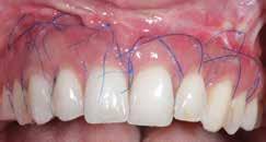 The shrinkage after light-curing physically locks the composite material between the teeth and provides support for the sutures.
