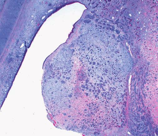 Anatomic Pathology / Original Article Image 1 (Case 5) Low-power view of endobronchial tumor component protruding into the bronchial lumen (H&E, 4).