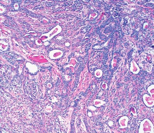 Image 4 (Case 3) Epithelial duct-like structures interspersed with tumor (H&E, 20). component composed of a myxochondroid stroma Image 5.