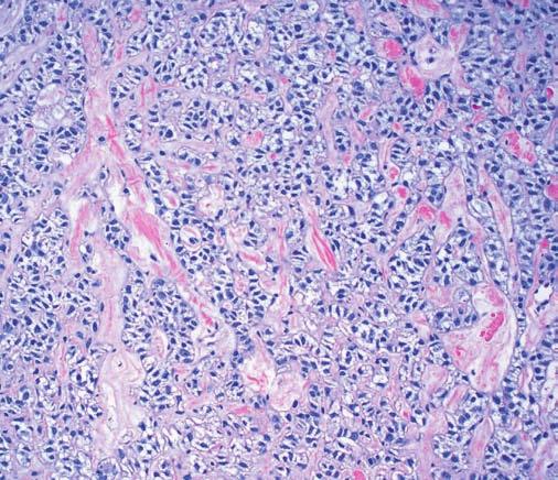 In 2 cases, small areas of hyalinization containing a more bland-appearing myoepithelial cell proliferation could be seen.