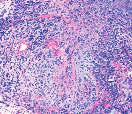 Weissferdt and Moran / Pulmonary Salivary Gland Type Tumors Image 5 (Case 4) Prominent chondromyxoid stromal background (H&E, 20).