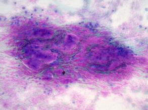 myoepithelial carcinoma (Polymorphous low grade adenocarcinoma) Pleomorphic